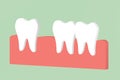 Spacing teeth diastema