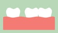 Spacing teeth diastema , space between tooth in mouth