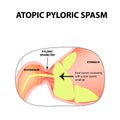 Spasms of the pylorus. Pylorospasm. atonic. Pyloric sphincter of the stomach. Infographics. Vector image on isolated background