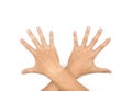 Spastic hand. Hand muscle spasticity Royalty Free Stock Photo