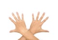 Spastic hand. Hand muscle spasticity Royalty Free Stock Photo