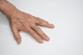 Spastic hand. Hand muscle spasticity Royalty Free Stock Photo