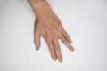 Spastic hand. Hand muscle spasticity Royalty Free Stock Photo