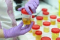 Preparation of urine samples in the laboratory in the hospital for the study. Special test strips for urine examination