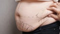 Correction marks for cosmetic liposuction on female belly Royalty Free Stock Photo