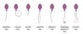 Spermogram and semen parameters, teratozoospermia, normal and abnormal sperm. Head defects spermatozoon.