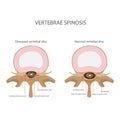 Spin stenosis. vertebrae disease