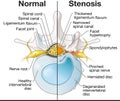 Spinal Canal Stenosis. Lumbar vertebra with intervertebral disc and herniated nucleus pulposus, illustration Royalty Free Stock Photo