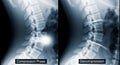 Spinal Compression and Decompression X-Ray Royalty Free Stock Photo