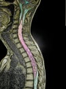 spinal cord tumor, illustration, MRI Royalty Free Stock Photo