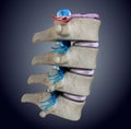 Spinal cord under pressure of bulging disc Royalty Free Stock Photo