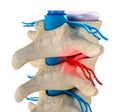 Spinal cord under pressure of bulging disc