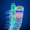 Spinal cord under pressure of bulging disc. Medically accurate 3D illustration