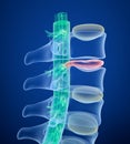 Spinal cord under pressure of bulging disc, X-Ray view. Royalty Free Stock Photo