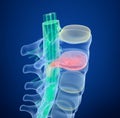 Spinal cord under pressure of bulging disc, X-Ray view. Royalty Free Stock Photo