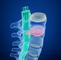 Spinal cord under pressure of bulging disc, X-Ray view. Royalty Free Stock Photo