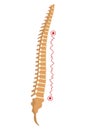 Spinal deformity. Symbol of spine curvatures or unhealthy backbones. Human spine anatomy, curved spine. Diagram with Royalty Free Stock Photo