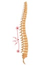 Spinal deformity. Symbol of spine curvatures or unhealthy backbones. Human spine anatomy, curved spine. Diagram with Royalty Free Stock Photo