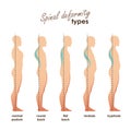 Spinal deformity types. Diseases of the spine.Lordosis, kyphosis, round back, flat back. Vector human silhouettes