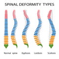 Spinal deformity types. Royalty Free Stock Photo