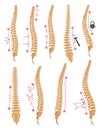 Spinal deformity types. Symbols of spine curvatures or unhealthy backbones. Human spine anatomy, curved spine. Diagram