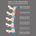 Spinal disc degeneration illustration, educational medical illustration, spine disease options, flat style, idea for your Royalty Free Stock Photo