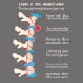 Spinal disc degeneration illustration, educational medical illustration, spine disease options, flat style, idea for