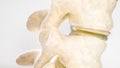 Spinal disc herniation as close-up as 3D Rendering Royalty Free Stock Photo