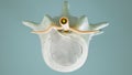 Spinal disc herniation as close-up as 3D Rendering Royalty Free Stock Photo