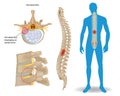 Spinal Disc Herniation. Back Pain Human. Spinal Cord Compression. Bulging disc. Royalty Free Stock Photo