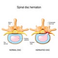Normal disc and spinal disc herniation in cervical vertebrae Royalty Free Stock Photo