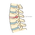 Spinal disc herniation diagram medical science Royalty Free Stock Photo