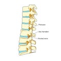 Spinal disc herniation diagram medical science Royalty Free Stock Photo