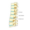 Spinal disc herniation diagram medical science