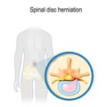 Spinal disc herniation Royalty Free Stock Photo