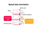 Spinal disc herniation illustration Royalty Free Stock Photo