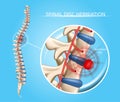 Spinal Disk Herniation Vector Medical Scheme
