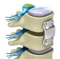 Spinal fixation system - titanium bracket Royalty Free Stock Photo