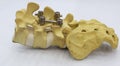 Spinal fixation system - titanium bracket Royalty Free Stock Photo