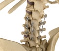 Spinal fixation system - titanium bracket. Medically accurate