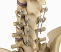 Spinal fixation system - titanium bracket. Royalty Free Stock Photo