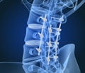 Spinal fixation system - titanium bracket. X-ray view Royalty Free Stock Photo