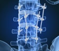 Spinal fixation system - titanium bracket. X-ray view.