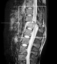 Fracture spin, cord interruption, compression. CT-scan. Royalty Free Stock Photo