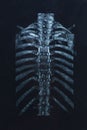 Spinal fracture. pins in the spine. thoracic spine. multiple myeloma myeloma. spine x-ray