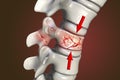 Spinal fracture, traumatic vertebral injury, illustration