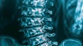 Spinal fusion surgery with metal rods and screws an X-ray view of the spine
