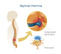 Spinal Hernia Anatomy Infographics