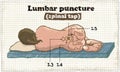 Spinal Lumbar Puncture Illustration on old Paper