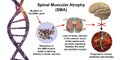 Spinal muscular atrophy, SMA, a genetic neuromuscular disorder with progressive muscle wasting Royalty Free Stock Photo